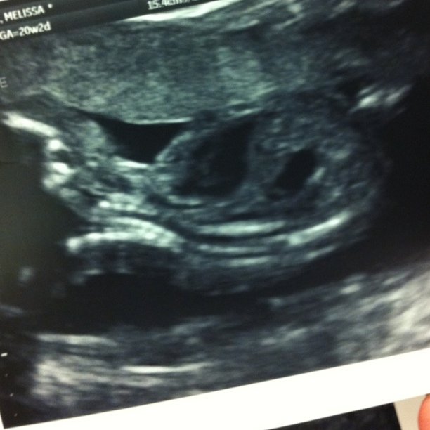 We are having a girl!